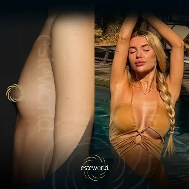 venus-before-after5