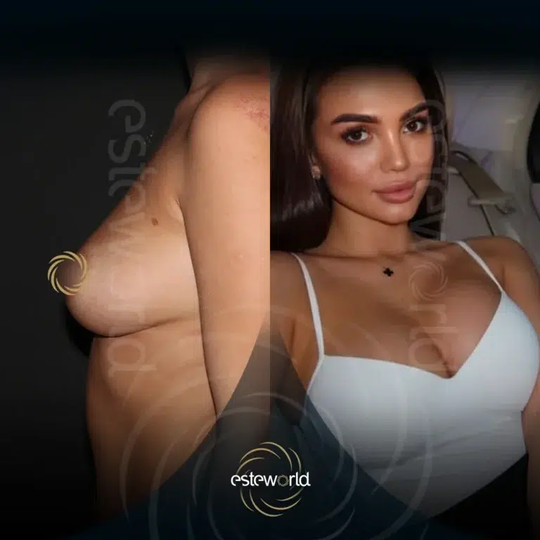venus-before-after9